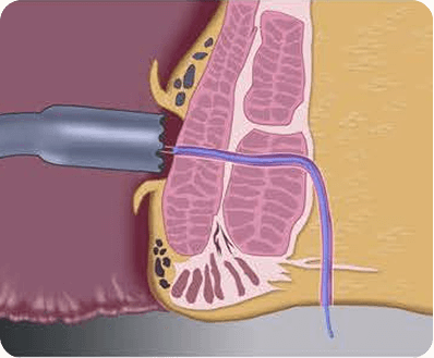 Illustration of a medical instrument, such as the Signum Surgical device, inserted into a nasal cavity, showing internal nasal structures and a blue tube passing through the sinus area.
