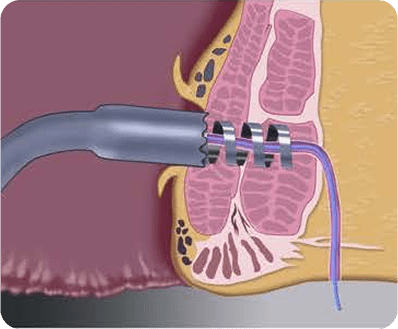 Medical illustration showing a Signum Surgical stapler being used on internal tissue, with a tube or catheter inserted alongside the stapler in the cross-sectioned area.