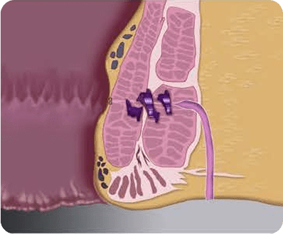 Medical illustration showing a cross-section of the anal canal with visibly swollen purple hemorrhoidal veins, indicating hemorrhoids. Surrounding tissue and muscle layers are also depicted in this Signum Surgical educational image.
