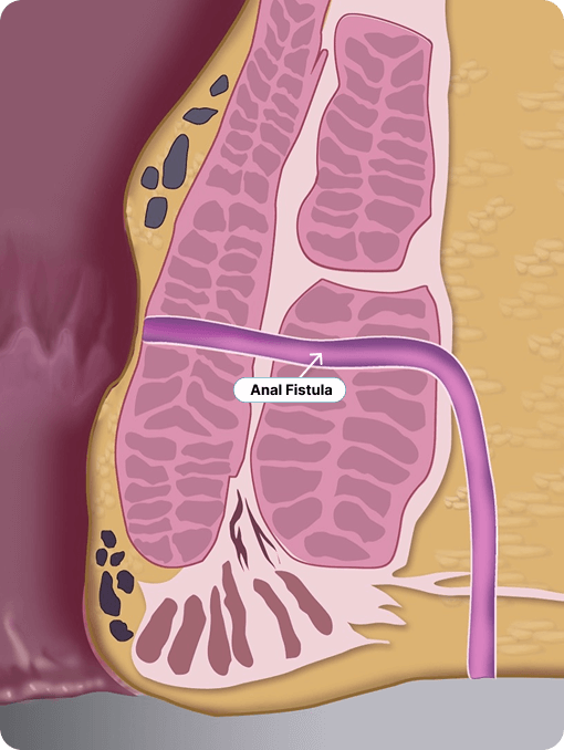 A medical illustration showing a cross-section of the rectal area with a labeled anal fistula, marked by a purple tract connecting the anal canal to the skin surface, highlighting the condition often treated by Signum Surgical solutions.
