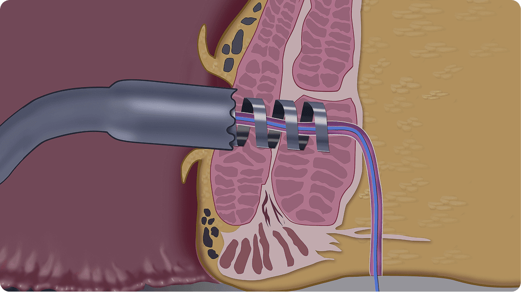 A medical illustration shows a Signum Surgical device performing a hemorrhoid banding procedure inside the rectal canal, with bands placed around enlarged blood vessels in the anal tissue.