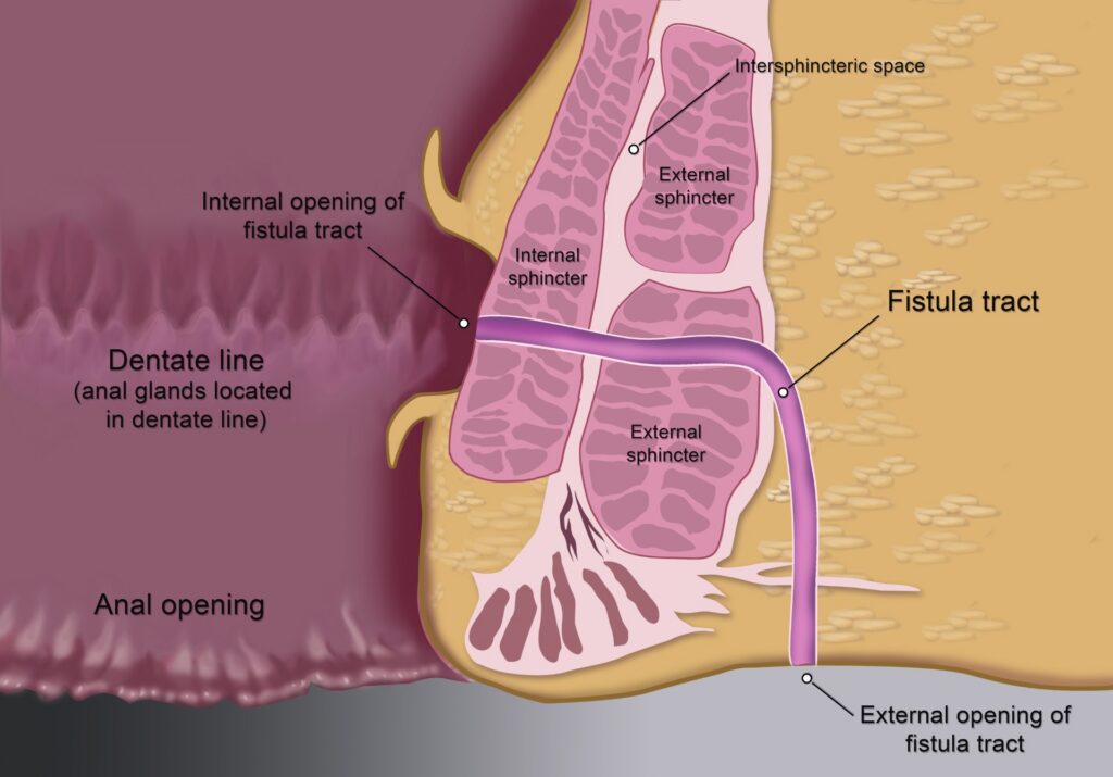 Diagram of an anal fistula showing the fistula tract, external and internal sphincter, intersphincteric space, internal opening of the fistula tract, dentate line and anal glands, the anal opening, and external opening of the fistula tract.