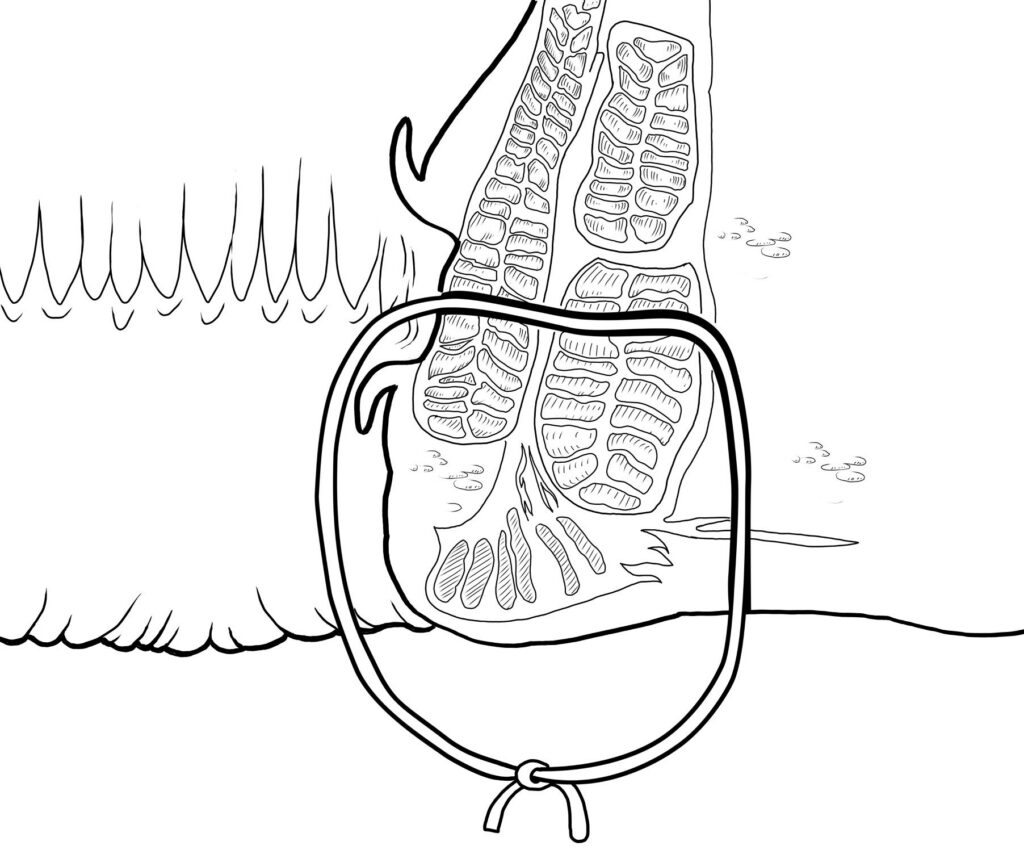 Black and white image of a draining seton in a patient diagnosed with an anal fistula which is placed before definitive surgery
