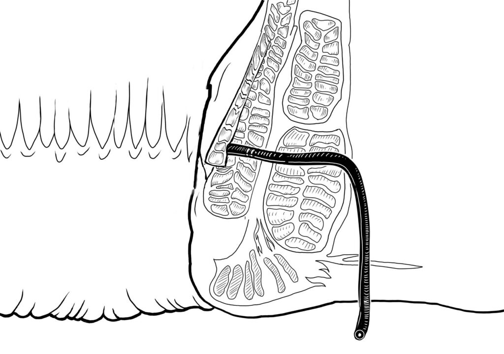 Black and white drawing or picture of a endoanal flap comprised of the internal anal sphincter and the overlying anal skin where the internal opening is closed with a flap of rectal lining and underlying tissue with success rates