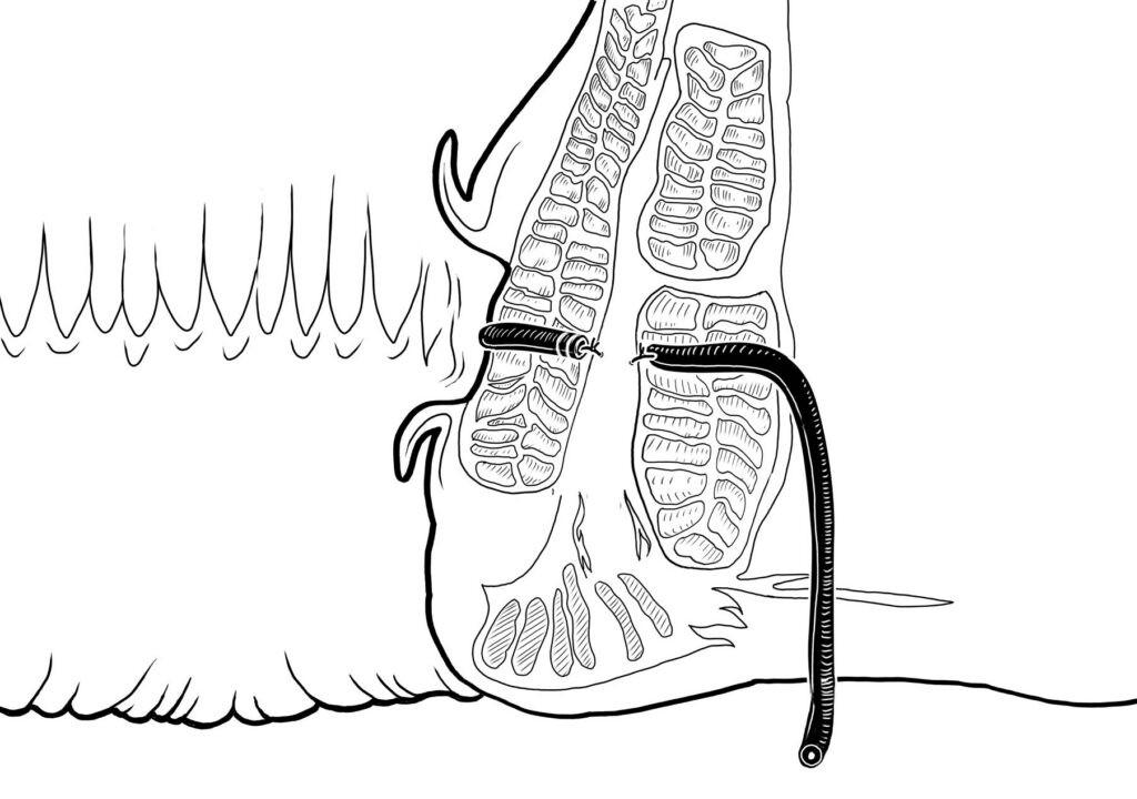 Black and white picture of LIFT or Ligation of the Intersphincteric Fistula Tract surgery procedure where the internal and external sphincters is divided by a surgeon with a suture closure of the cut ends of the fistula tract
