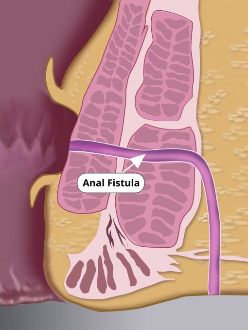 rendered image of an anal fistula tract labelled with an arrow to show exactly where it is and where treatment is applied